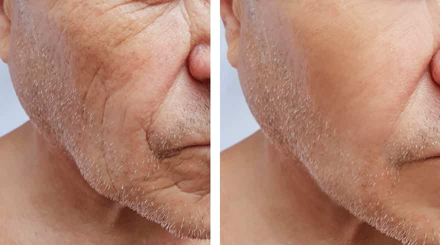 Wrinkles injection treatment